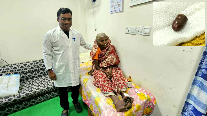 আন্দোলনে গুলিবিদ্ধ ১১০ দিন পর ভিক্ষুকের পা থেকে বুলেট অপসারণ
